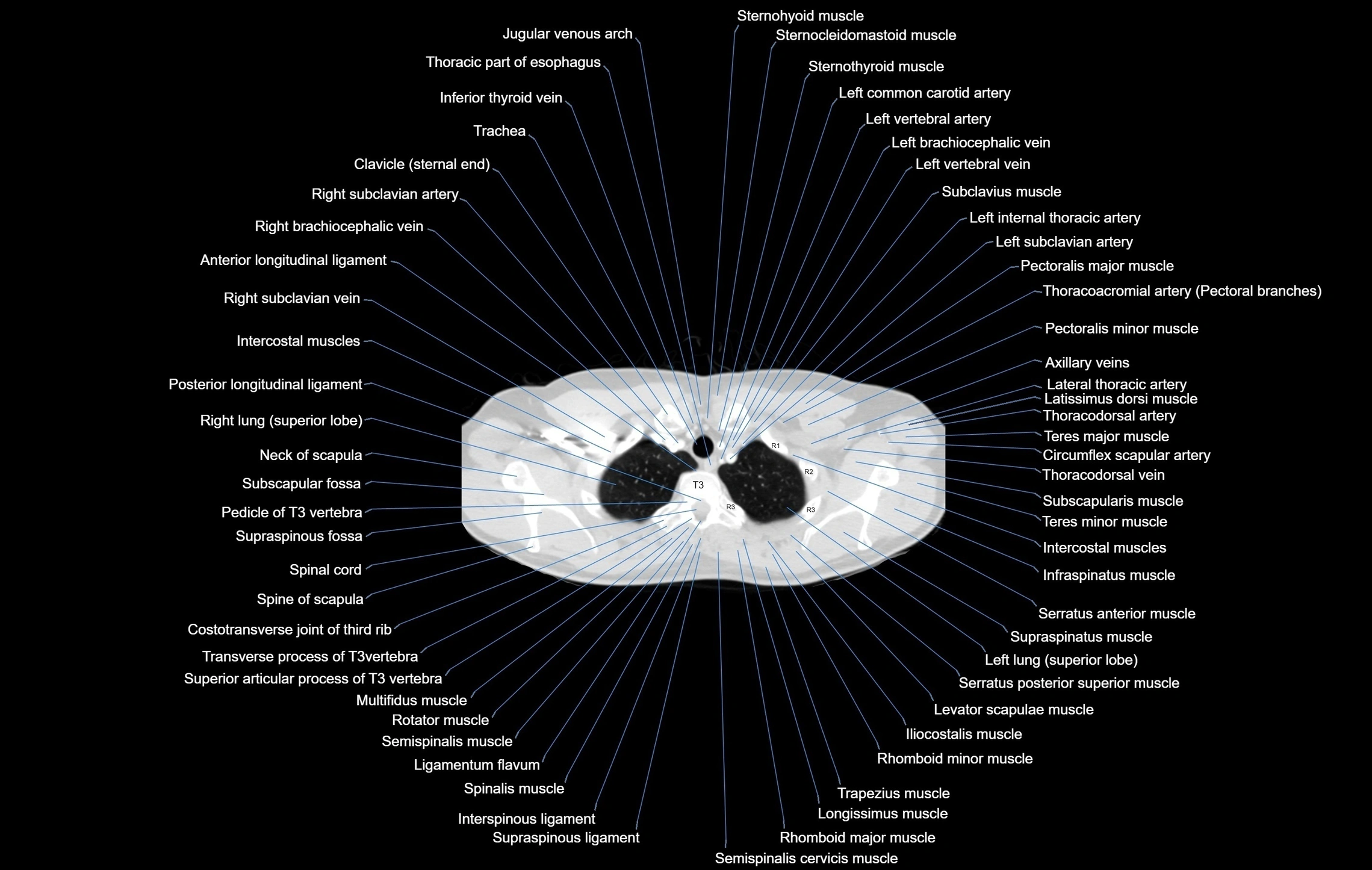 CT chest (thorax) labelled axial cross sectional anatomy radiology image-00015.webp